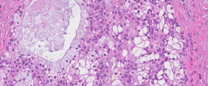 Understanding Mucoepidermoid Carcinoma - Pathology Outlines